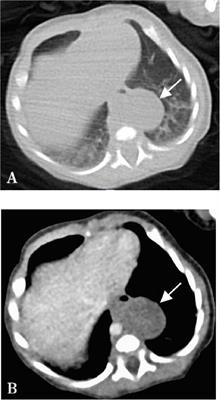 Posterior mediastinal extralobar pulmonary sequestration in a neonate with pulmonary artery supply: a case report